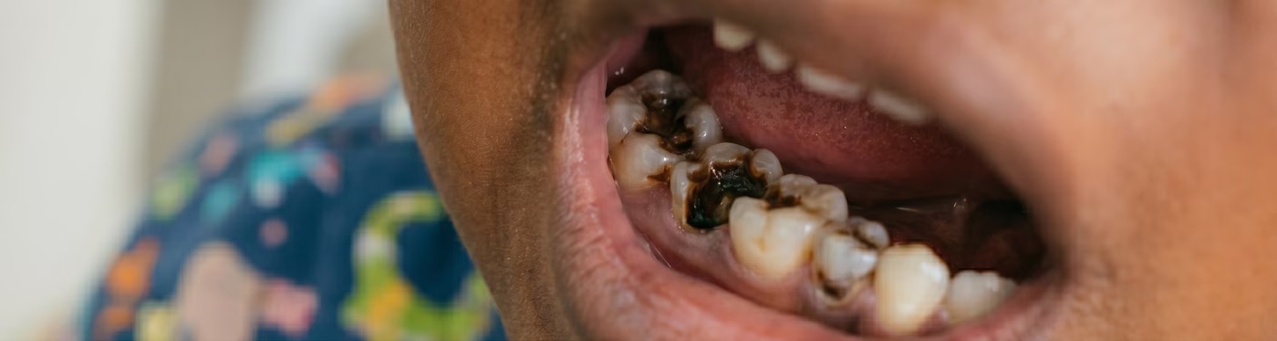 Before ceramic filling